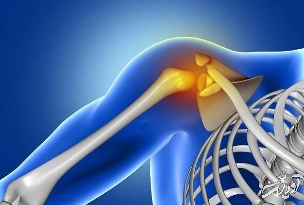 سندرم شانه یخ زده